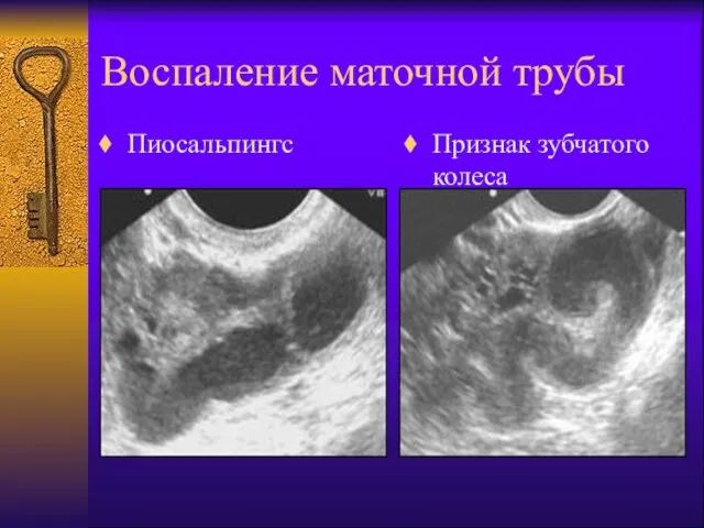 Воспаление маточной трубы Пиосальпингс Признак зубчатого колеса