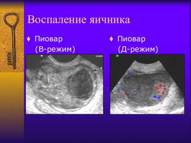 Воспаление яичника Пиовар (В-режим) Пиовар (Д-режим)