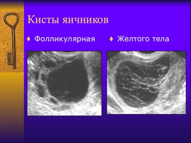 Кисты яичников Фолликулярная Желтого тела