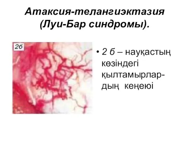 Атаксия-телангиэктазия (Луи-Бар синдромы). 2 б – науқастың көзіндегі қылтамырлар-дың кеңеюі