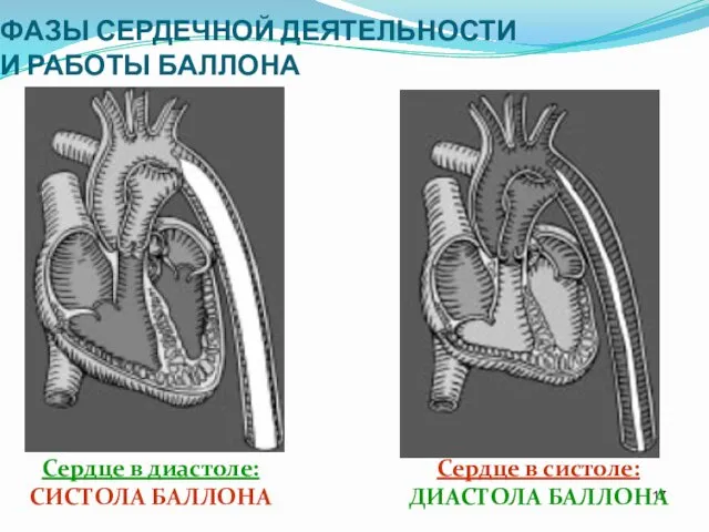 ФАЗЫ СЕРДЕЧНОЙ ДЕЯТЕЛЬНОСТИ И РАБОТЫ БАЛЛОНА Сердце в диастоле: СИСТОЛА БАЛЛОНА Сердце в систоле: ДИАСТОЛА БАЛЛОНА