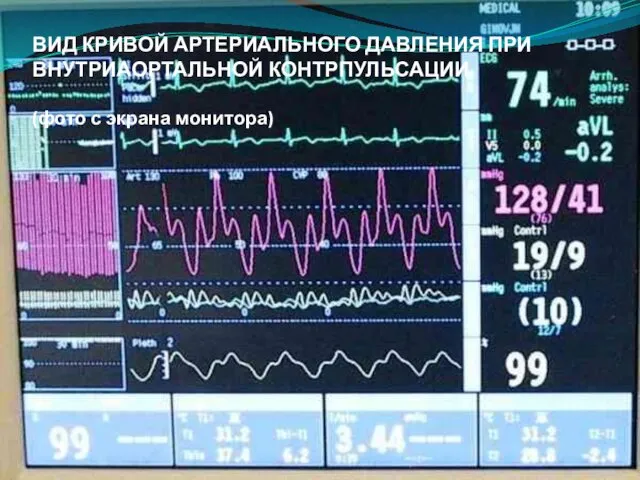 ВИД КРИВОЙ АРТЕРИАЛЬНОГО ДАВЛЕНИЯ ПРИ ВНУТРИАОРТАЛЬНОЙ КОНТРПУЛЬСАЦИИ (фото с экрана монитора)