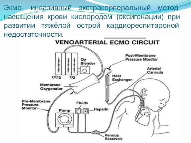 Экмо- инвазивный экстракорпоральный метод насыщения крови кислородом (оксигенации) при развитии тяжёлой острой кардиореспитароной недостаточности.