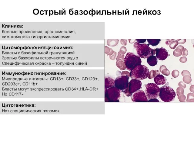 Острый базофильный лейкоз Клиника: Кожные проявления, органомегалия, симптоматика гипергистаминемии Цитоморфология/Цитохимия: Бласты