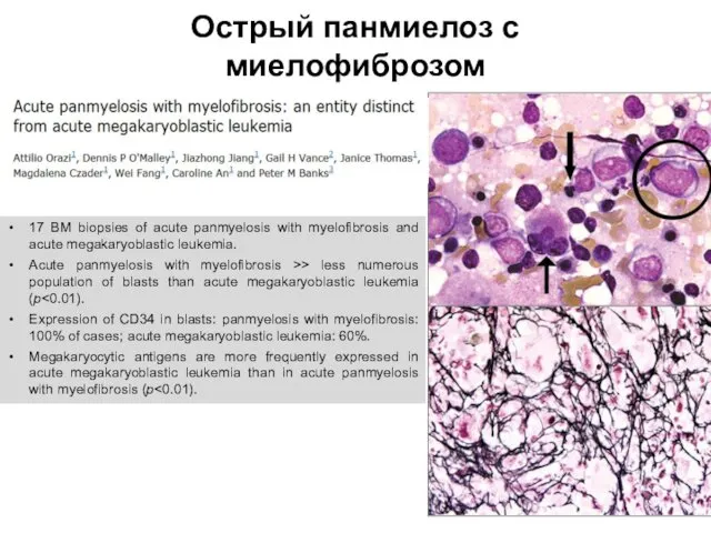 Острый панмиелоз с миелофиброзом 17 BM biopsies of acute panmyelosis with