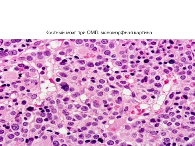 Костный мозг при ОМЛ: мономорфная картина