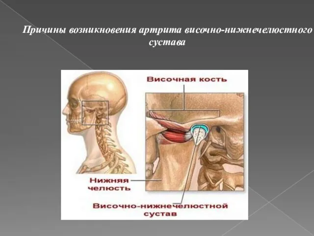 Строение височно-нижнечелюстного сустава Причины возникновения артрита височно-нижнечелюстного сустава