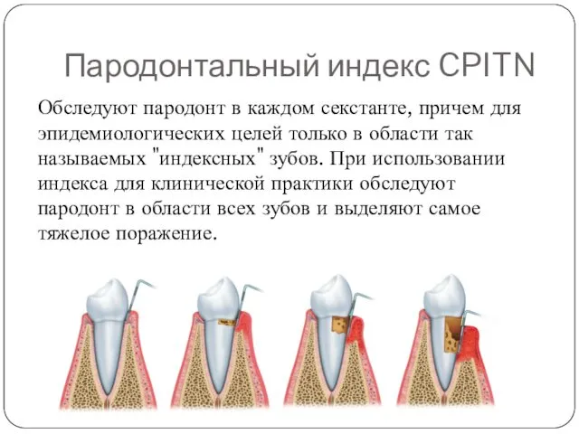 Пародонтальный индекс CPITN Обследуют пародонт в каждом секстанте, причем для эпидемиологических