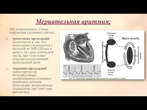 Мерцательная аритмия; МА подразумевает 2 вида нарушения сердечного ритма: трепетание предсердий