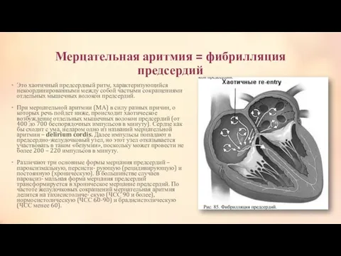 Мерцательная аритмия = фибрилляция предсердий Это хаотичный предсердный ритм, характеризующийся некоординированными