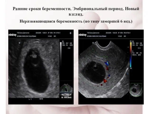 Ранние сроки беременности. Эмбриональный период. Новый взгляд. Неразвивающаяся беременность (по типу замершей 6 нед.)