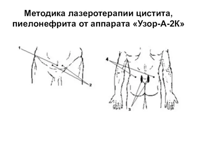 Методика лазеротерапии цистита, пиелонефрита от аппарата «Узор-А-2К»