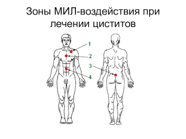 Зоны МИЛ-воздействия при лечении циститов