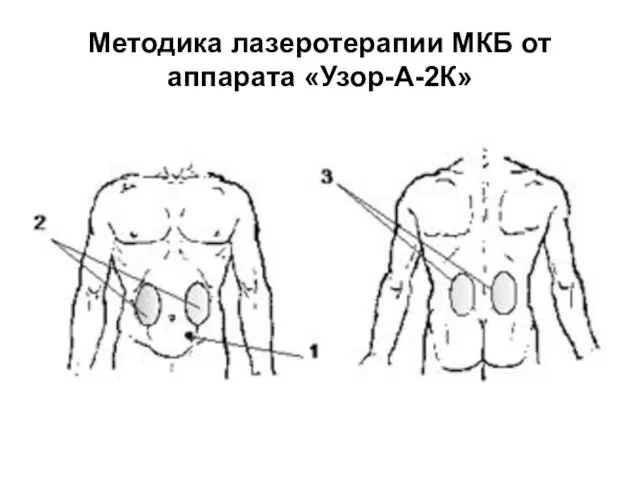 Методика лазеротерапии МКБ от аппарата «Узор-А-2К»