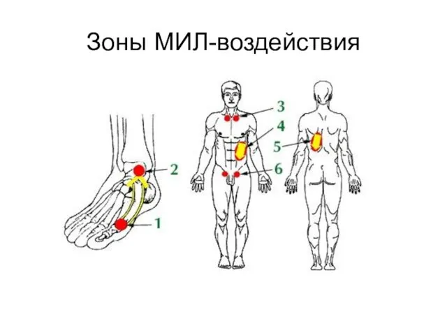 Зоны МИЛ-воздействия