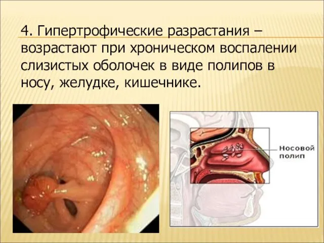 4. Гипертрофические разрастания – возрастают при хроническом воспалении слизистых оболочек в