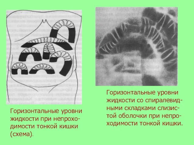 Горизонтальные уровни жидкости при непрохо-димости тонкой кишки (схема). Горизонтальные уровни жидкости