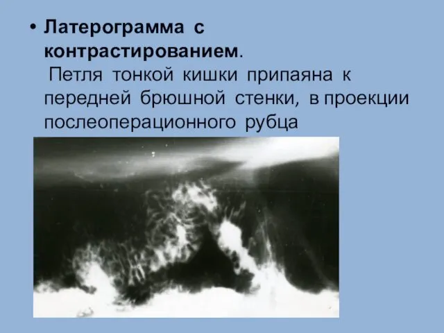 Латерограмма с контрастированием. Петля тонкой кишки припаяна к передней брюшной стенки, в проекции послеоперационного рубца