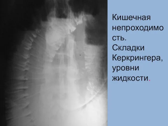 Кишечная непроходимость. Складки Керкрингера, уровни жидкости.