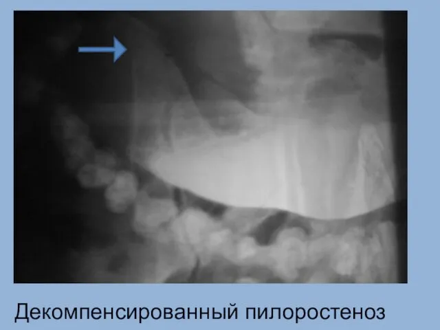 Декомпенсированный пилоростеноз