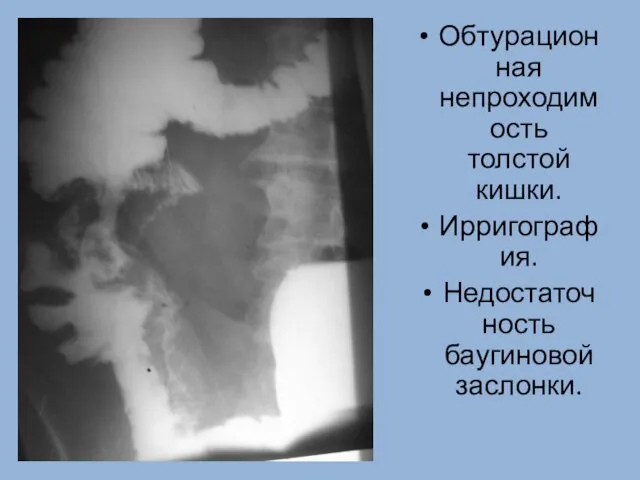 Обтурационная непроходимость толстой кишки. Ирригография. Недостаточность баугиновой заслонки.