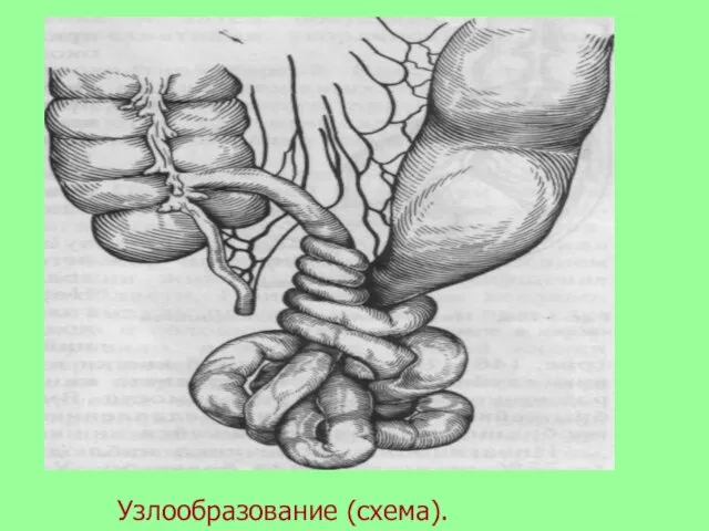 Узлообразование (схема).