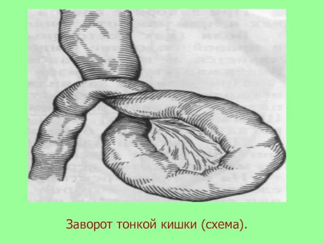 Заворот тонкой кишки (схема).