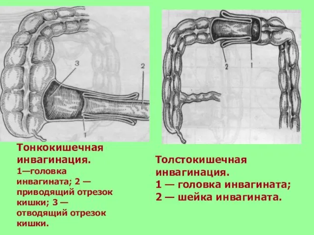 Тонкокишечная инвагинация. 1—головка инвагината; 2 — приводящий отрезок кишки; 3 —