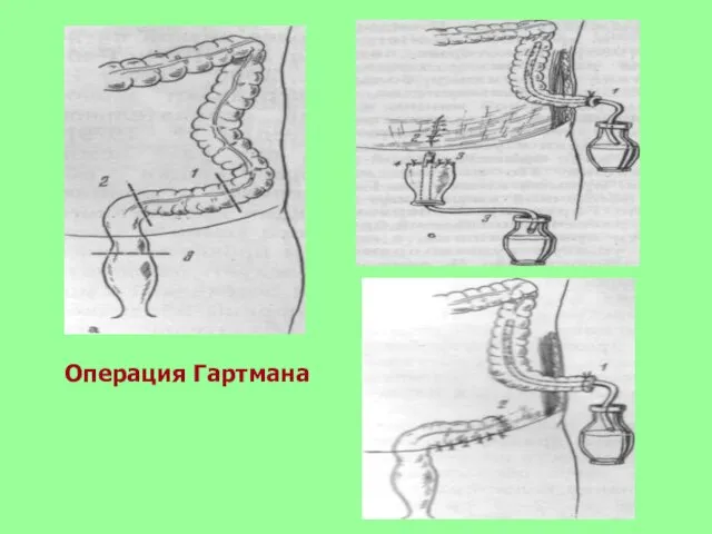 Операция Гартмана