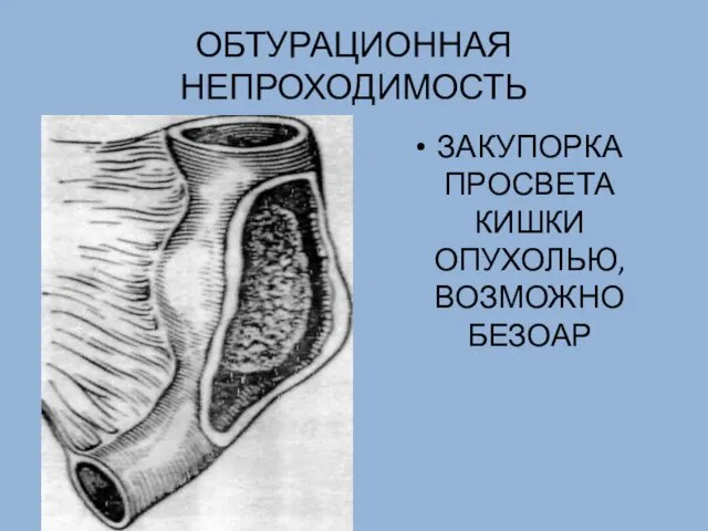 ОБТУРАЦИОННАЯ НЕПРОХОДИМОСТЬ ЗАКУПОРКА ПРОСВЕТА КИШКИ ОПУХОЛЬЮ, ВОЗМОЖНО БЕЗОАР