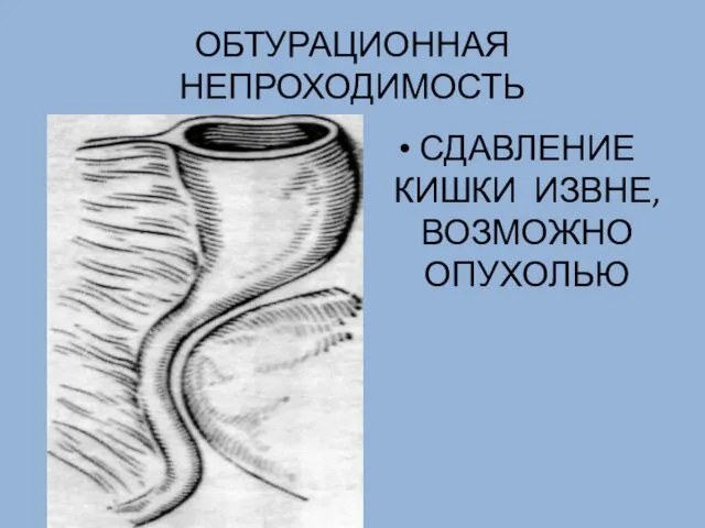 ОБТУРАЦИОННАЯ НЕПРОХОДИМОСТЬ СДАВЛЕНИЕ КИШКИ ИЗВНЕ, ВОЗМОЖНО ОПУХОЛЬЮ