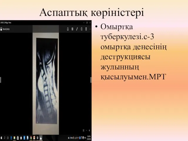 Аспаптық көріністері Омыртқа туберкулезі.с-3 омыртқа денесінің деструкциясы жулынның қысылуымен.МРТ