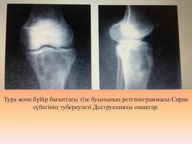 Тура және бүйір бағыттағы тізе буынының ретгенограммасы:Сирақ сүйегінің туберкулезі.Деструкциялы ошақтар.