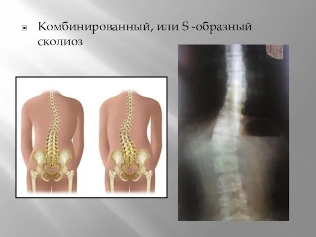 Комбинированный, или S -образный сколиоз