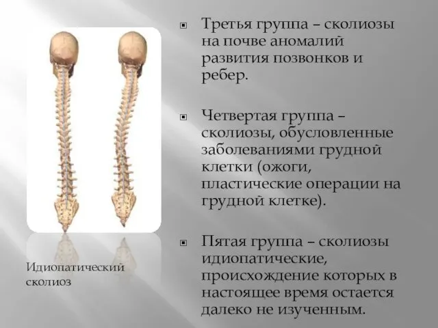 Идиопатический сколиоз Третья группа – сколиозы на почве аномалий развития позвонков