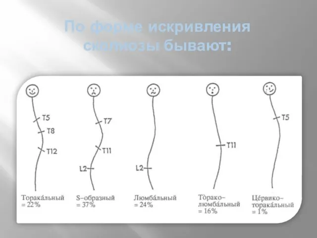 По форме искривления сколиозы бывают: