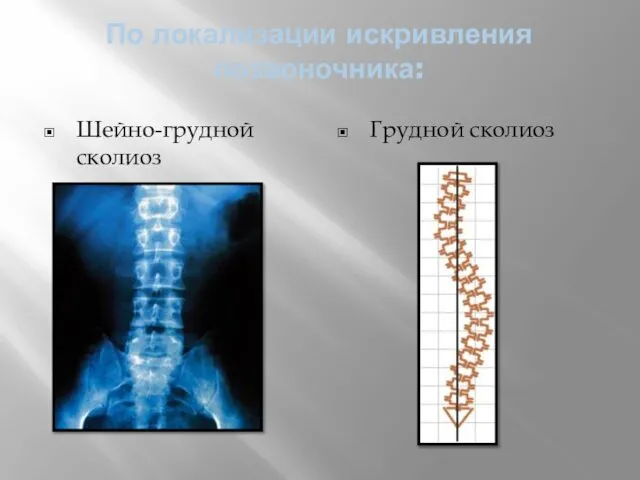 По локализации искривления позвоночника: Шейно-грудной сколиоз Грудной сколиоз