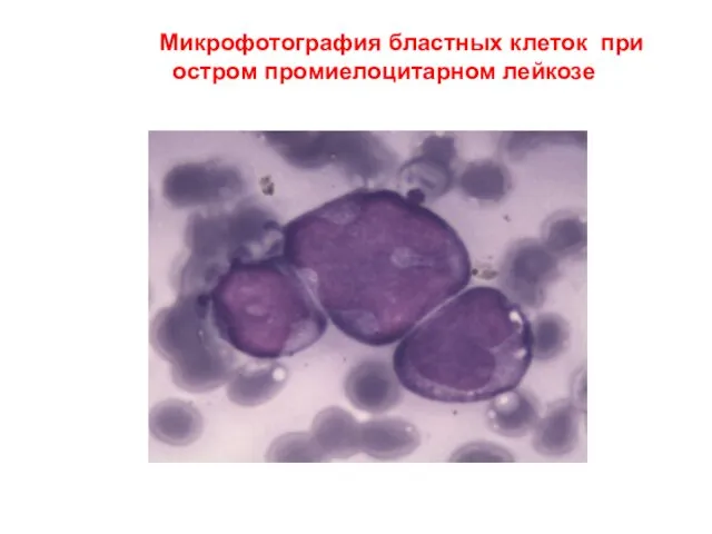 Микрофотография бластных клеток при остром промиелоцитарном лейкозе