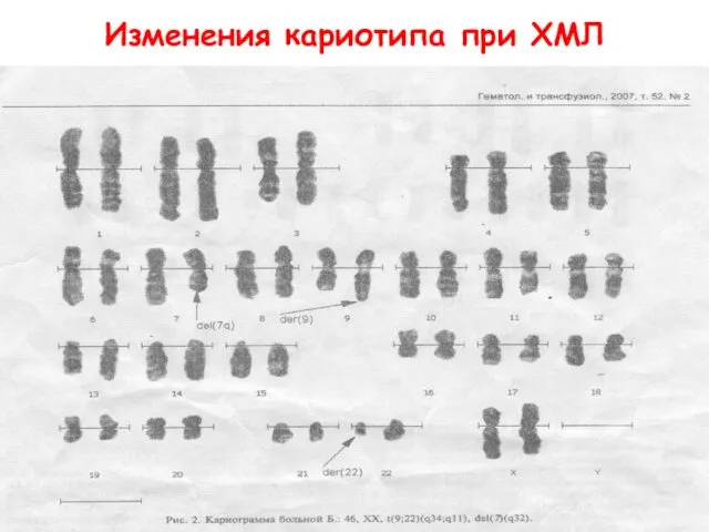 Изменения кариотипа при ХМЛ