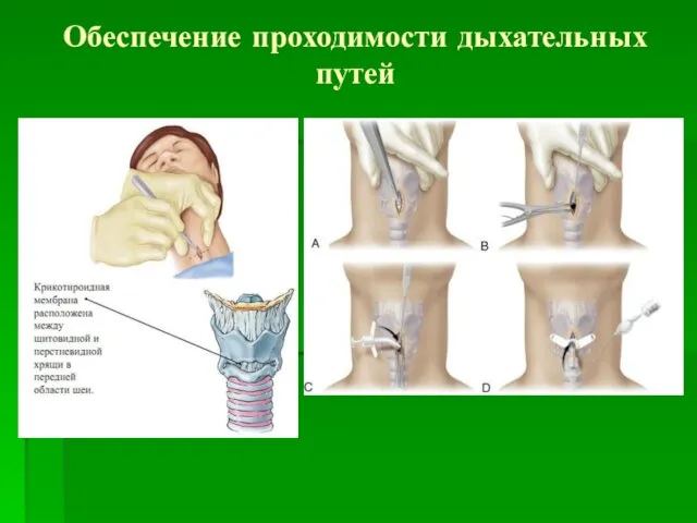 Обеспечение проходимости дыхательных путей