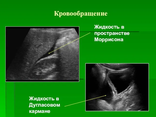 Кровообращение Жидкость в пространстве Моррисона Жидкость в Дугласовом кармане