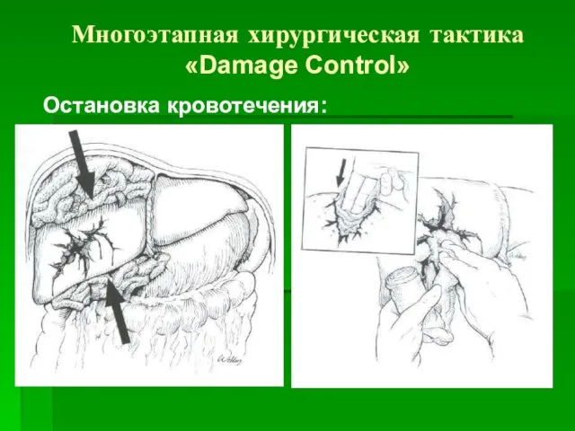 Многоэтапная хирургическая тактика «Damage Control» Остановка кровотечения: