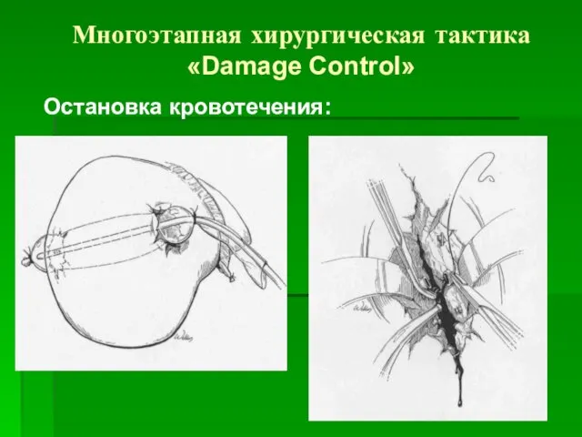 Многоэтапная хирургическая тактика «Damage Control» Остановка кровотечения: