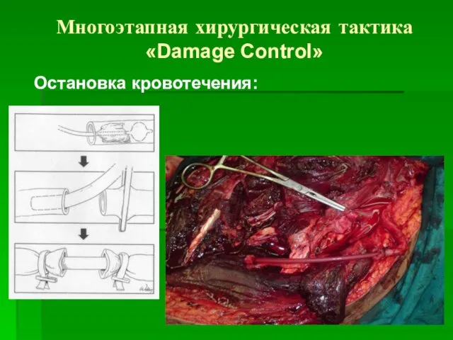 Многоэтапная хирургическая тактика «Damage Control» Остановка кровотечения: