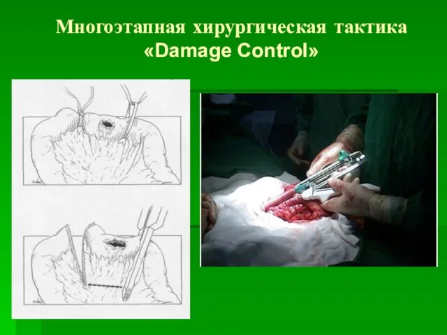 Многоэтапная хирургическая тактика «Damage Control»