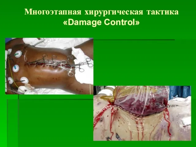 Многоэтапная хирургическая тактика «Damage Control»