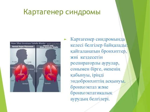 Картагенер синдромы Картагенер синдромында келесі белгілер байқалады: қайталанатын бронхиттер, жиі кездесетін