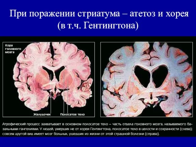 При поражении стриатума – атетоз и хорея (в т.ч. Гентингтона)