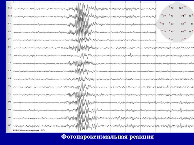 Фотопароксизмальная реакция