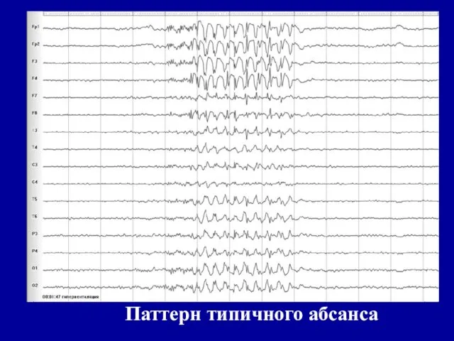 Паттерн типичного абсанса